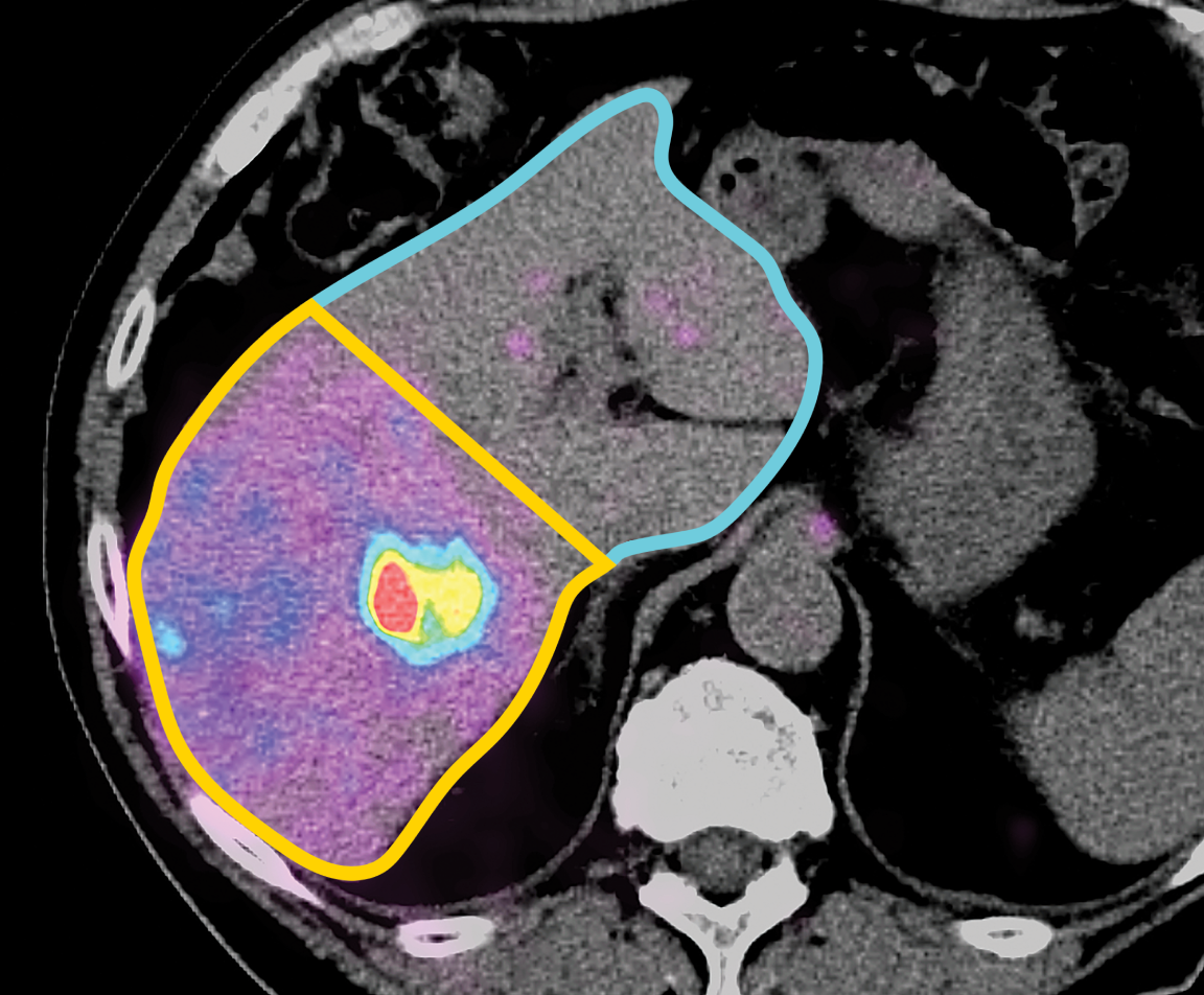 Show Proof of Value with Personalized Dosimetry with MIM SurePlan MRT